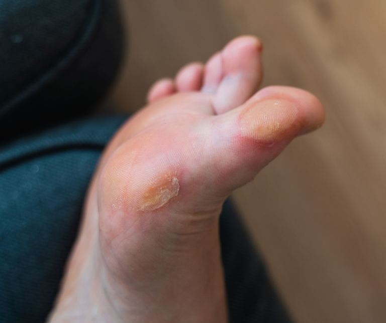 blisters on foot