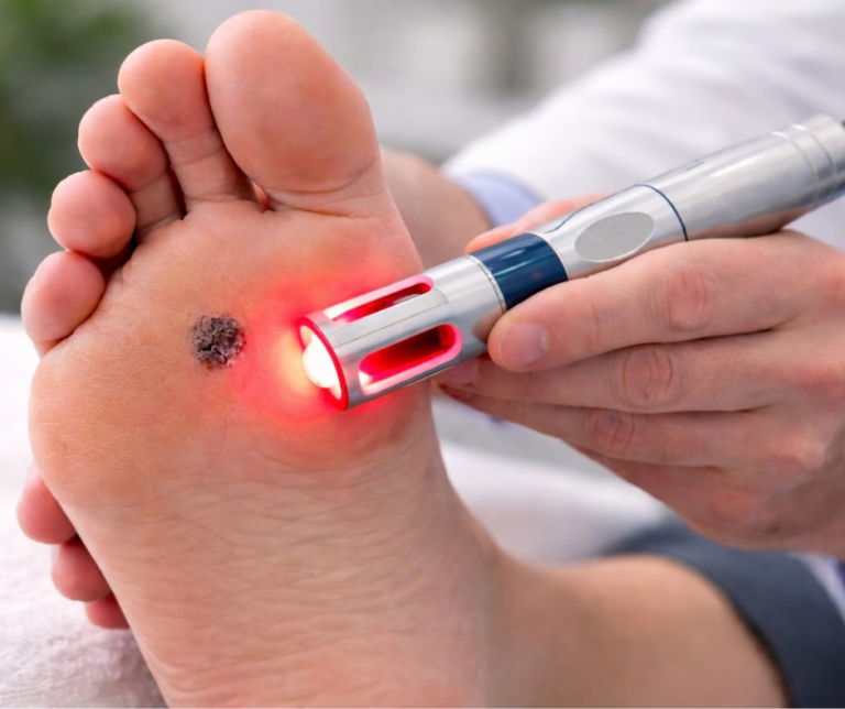 Remy laser treating foot